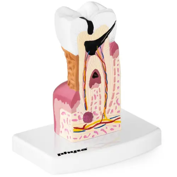 Maquette anatomique de la dentition humaine - Molaire malade